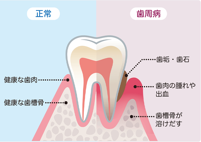 歯周病