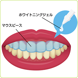 ホームホワイトニング