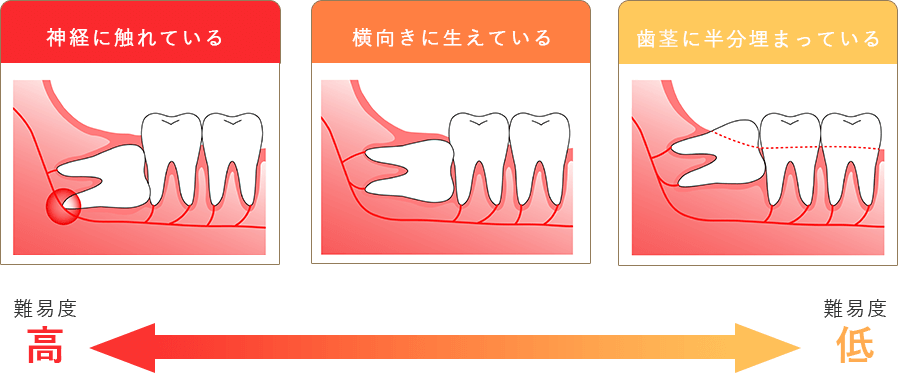 親知らずを抜いた方がいいケース