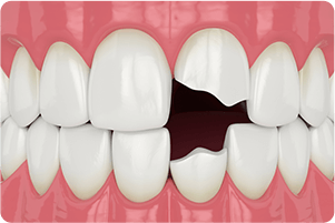 口腔内のケガ、歯の損傷