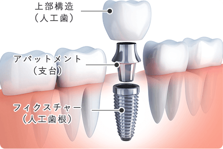 インプラントの仕組み