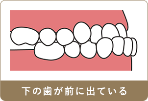 下の歯が前に出ている