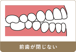 前歯が閉じない